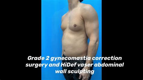 Grade 2 Gynecomastia Surgery And High Definition Abdominal Sculpting Results In Chicago Youtube