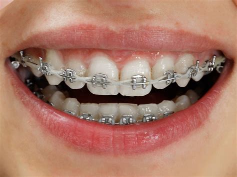 Metal Braces The Look Orthodontics