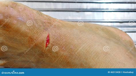 Foot Dressing Wound Stock Photo Image Of Treatment 46513428