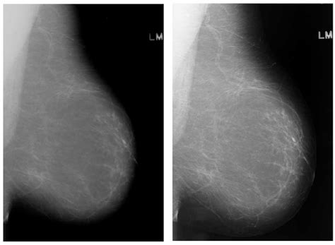 A Breast Mammograms Of Mostly Adipose Tissue Left Screenfilm