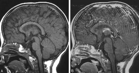 Pituitary Cysts In Childhood Evaluated By Mr Imaging American Journal
