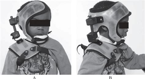 custom neck orthosis in combination with onabotulinumtoxina for the treatment of refractory