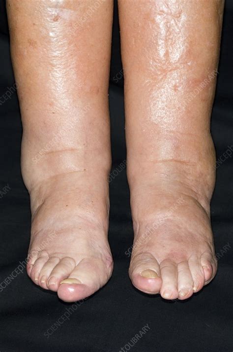 Ankle Oedema In Heart Failure Stock Image C0029611 Science Photo