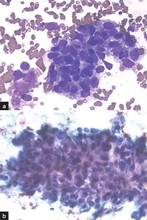 Robotic Microscopic Photographs Of Metastatic Adenocarcinoma In The Download Scientific Diagram