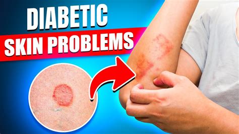 10 Common Diabetic Skin Problems You Shouldnt Ignore Youtube