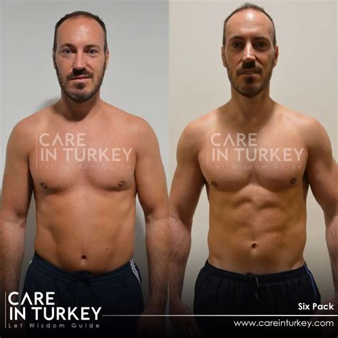 Six Pack Surgery Turkey Abdominal Etching Care In Turkey