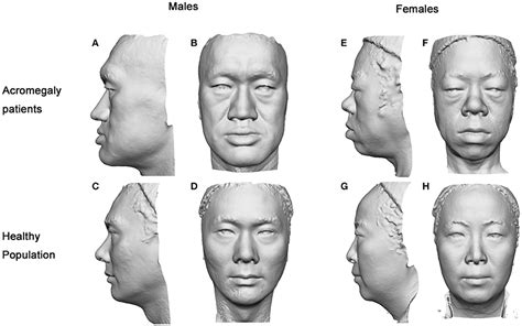frontiers 3d facial analysis in acromegaly gender specific features and clinical correlations
