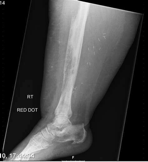 A ‘hot Leg A Rare Case Of Isolated Long Bone Metastases From Cervical