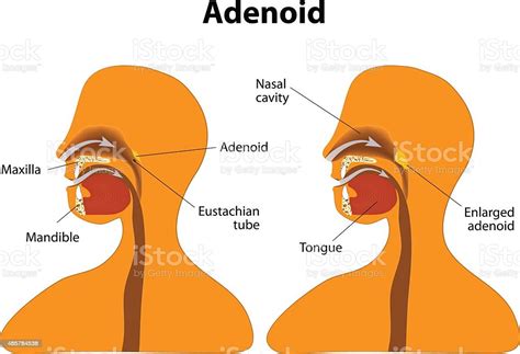 Adenoid Normal And Enlarged Adenoid Stock Illustration Download Image