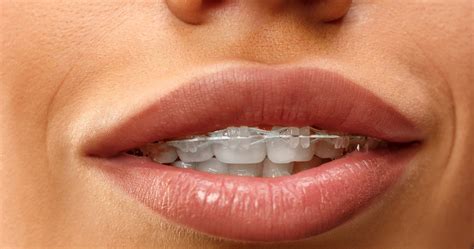 Overbite Correction Braces