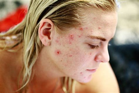 What Does Fungal Acne Look Like And Its Treatment Naturally How To Fit