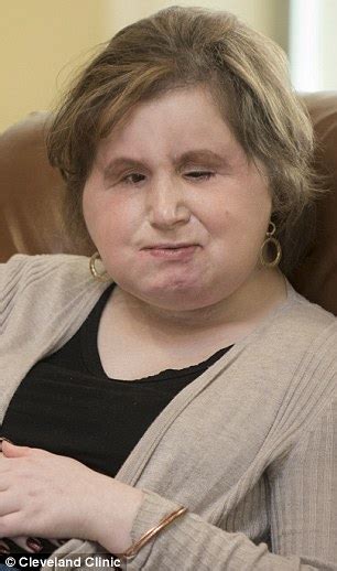 Katie Stubblefield Who Shot Her Face Off In A Failed Suicide Gets A Face Transplant Daily Mail