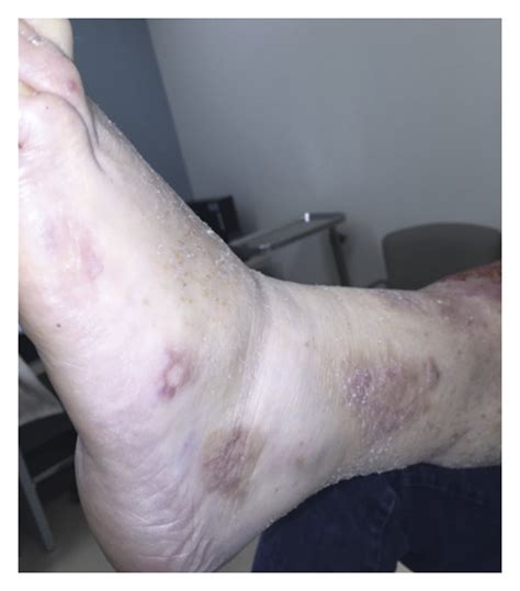 Pyoderma Gangrenosum Lesions 6 Months After Treatment Of Underlying