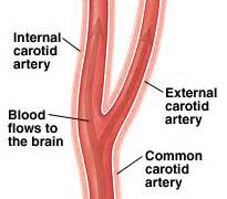 Carotid Artery Problems: Blockage