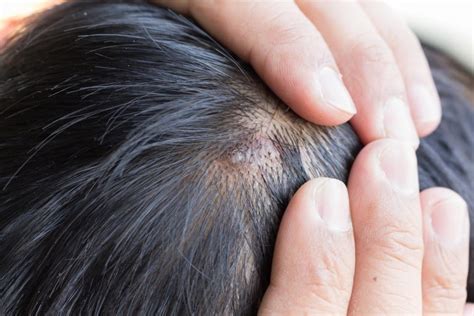 Scalp Acne Is A Real Thing Heres How To Banish It