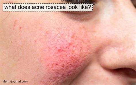 What Does Acne Rosacea Look Like International Journal Of Dermatology