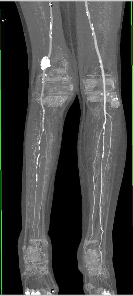 Cta Runoff With De Extensive Plaques In The Superficial Femoral Artery