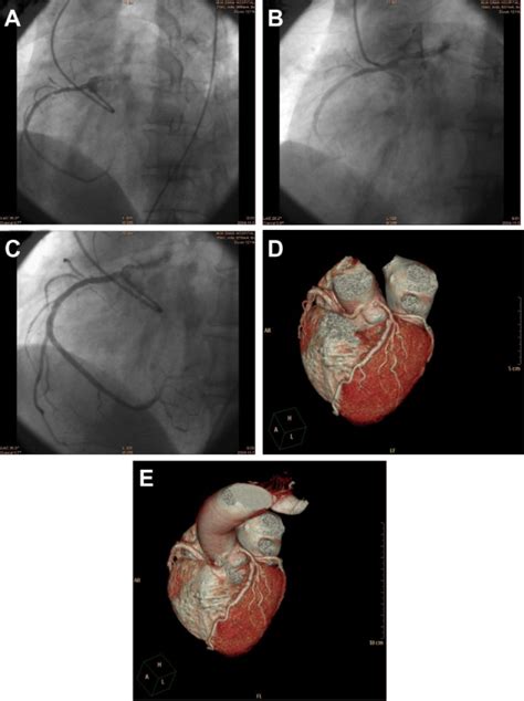 A Lao Cranial View Shows An Anomalous Rca Arising From The Left Sinus