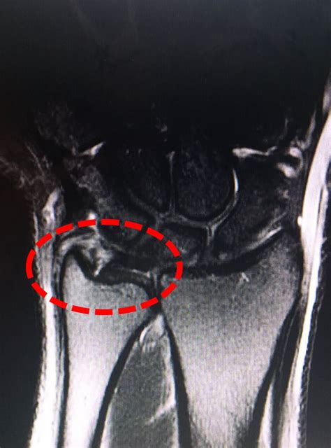 Exercícios Para Fibrocartilagem Triangular