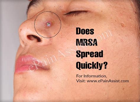 Is Mrsa A Communicable Disease Captions Todays