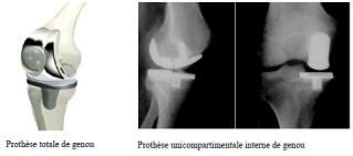 Quand la dégradation du cartilage est importante, l'opération est la solution pour retrouver son autonomie. Prothèse du genou Lyon, chirurgie, implant prothese totale ...