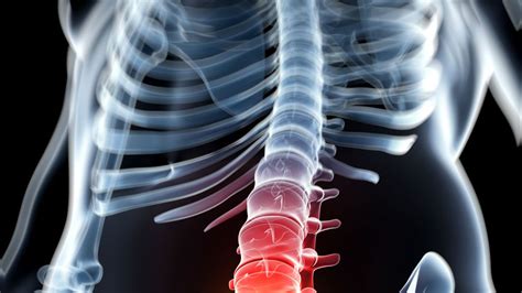 Paralítico logra caminar después de implantarle un dispositivo en la médula ósea