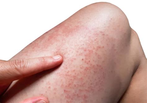 Allergy Related Rashes In Vernon Hills Food Allergy Testing In Vernon