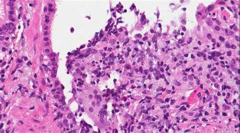 Pathology Outlines Lipoid Pneumonia