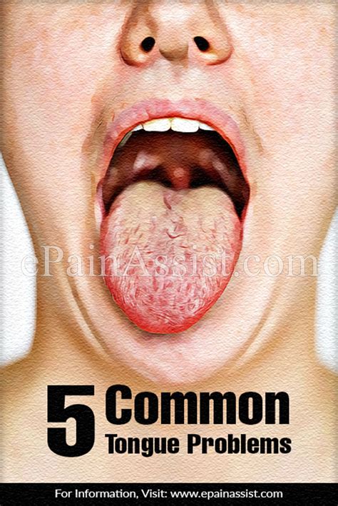 5 Common Tongue Problems