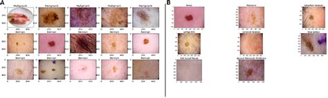 Frontiers Untangling Classification Methods For Melanoma Skin Cancer