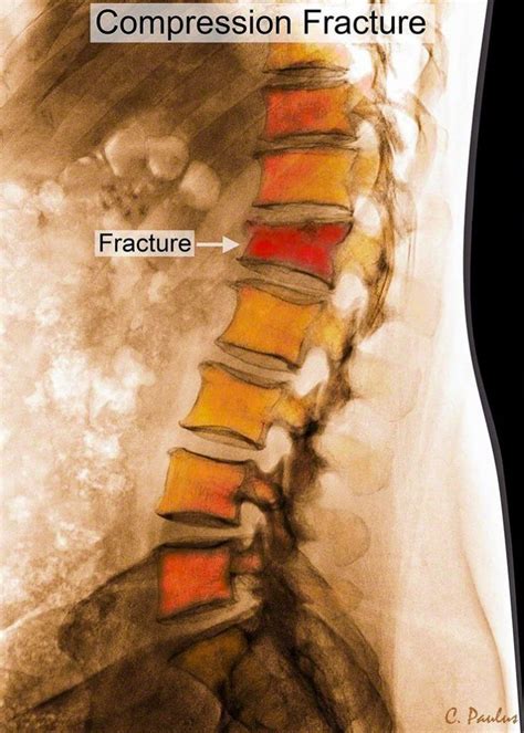 Understanding Spinal Fractures Causes Symptoms And Treatment Options