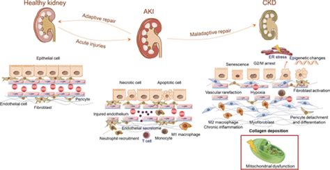 Mitochondrial Dysfunction And The Aki To Ckd Transition American