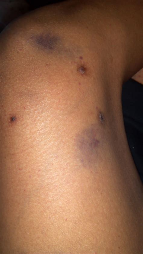 Dark Spots On Legs That Look Like Bruises Pictures Photos