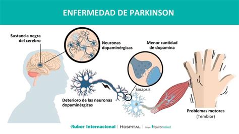 ¿qué Es La Enfermedad De Parkinson