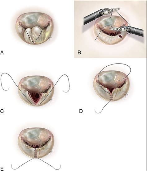 Mitral Valve Repair Techniques A Triangular Resection Of The
