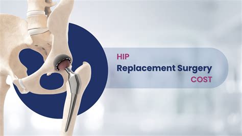 Average Hip Replacement Surgery Cost A Comprehensive Guide Wellness Hospitals