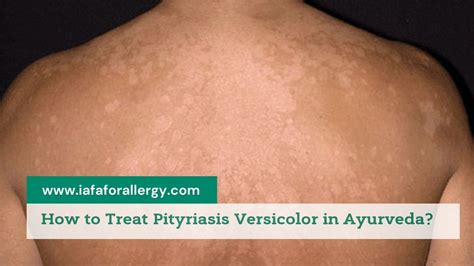 How To Treat Pityriasis Versicolor In Ayurveda