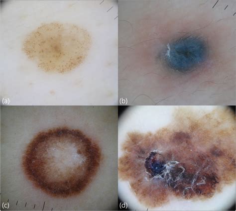 Dermoscopic Features Of A Melanocytic Nevus With A Globular And