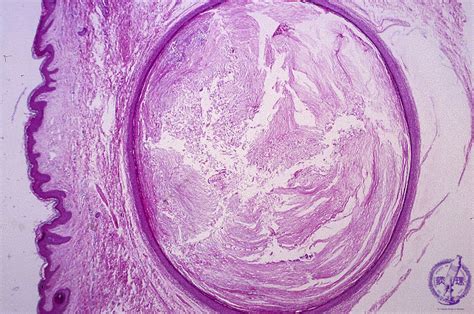 Skin Epidermal Cyst Pathology Core Pictures Sexiz Pix