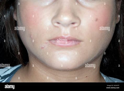 Swollen Parotid Glands In A 20 Year Old Female Patient With Mumps