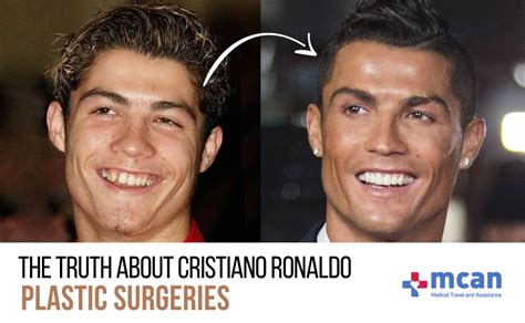 The Truth About Cristiano Ronaldo Plastic Surgeries