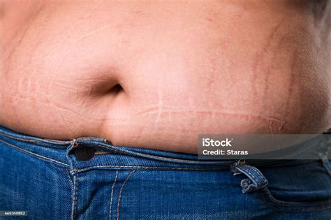 woman with fat abdomen in blue jeans overweight female stomach stretch marks on belly closeup
