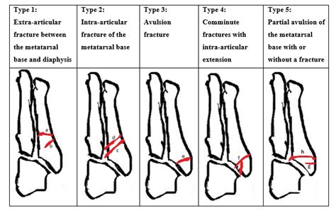 How Are Fifth Metatarsal Fractures Managed By The Virtual Fracture Clinic