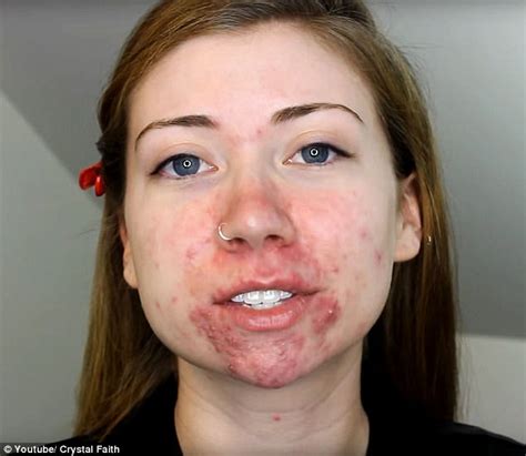 Woman With Severe Red Acne Gives Herself Flawless Skin Daily Mail Online