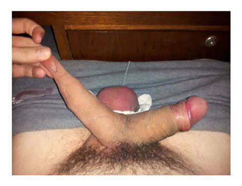 Man With Two Penises 22 Pics XHamster