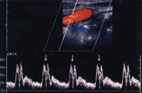 Figure 1 From Duplex Sonography Of The Carotid Arteries In Patients