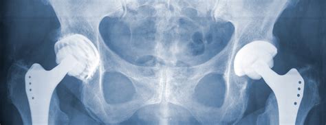 how effective is an anterior hip replacement aditi co