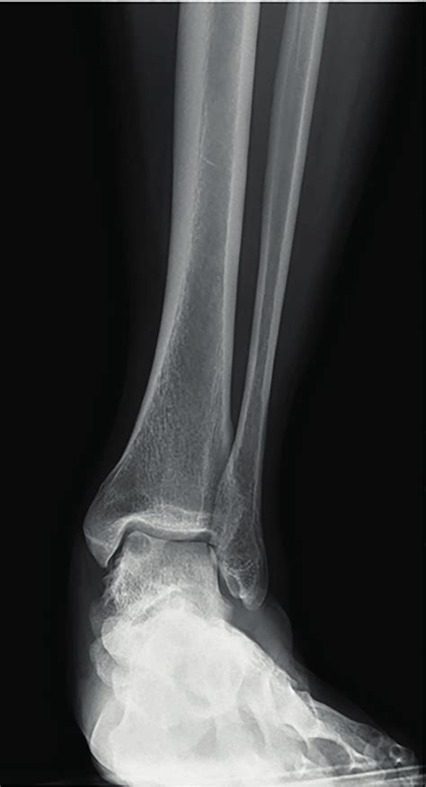 Anteroposterior Radiograph Of The Left Ankle Showing The Varus