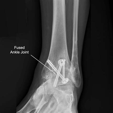Ankle Arthritis — Daniel Bohl Md Midwest Orthopaedics At Rush