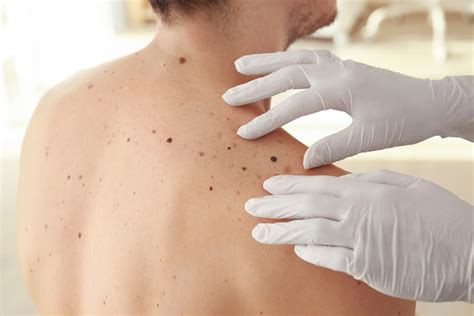 Skin Cancer Screening What To Expect Learnderm Inverness